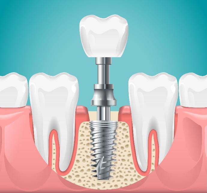 Impantología Dental